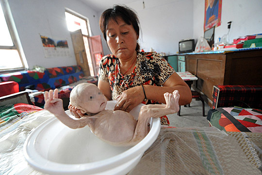 关注“无肛男婴”避免肛肠畸形疾病 我们在行动