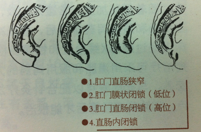 关注“无肛男婴”避免肛肠畸形疾病 我们在行动
